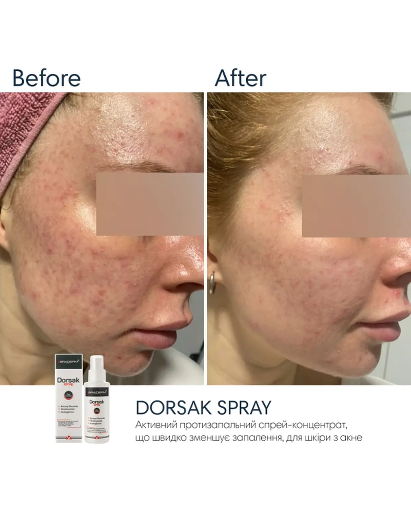 Активный противовоспалительный спрей с бензоил пероксидом 6% Braderm Dorsak Spray, 100 мл