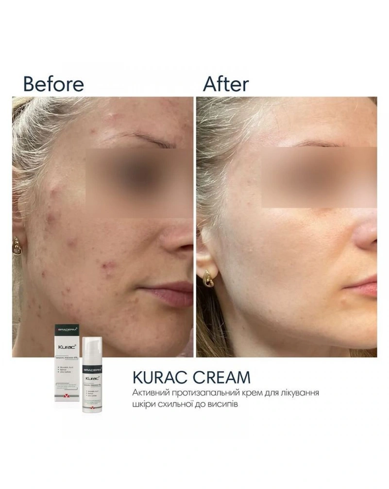 Активний протизапальний крем з бензоїл пероксидом 4% Braderm Kurac Cream, 30 мл
