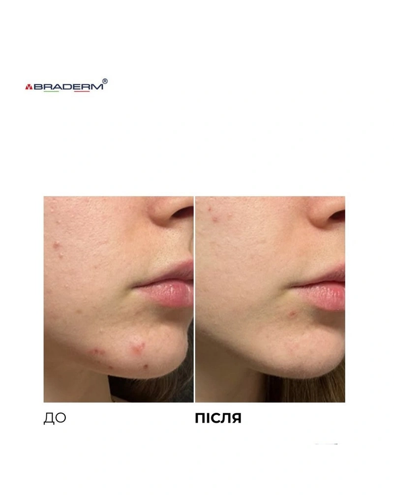 Крем для комплексного контроля акне и поддержки ремиссии Braderm Azekur Cream, 30 мл
