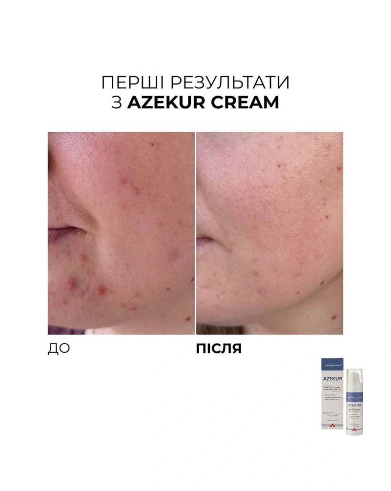 Крем для комплексного контроля акне и поддержки ремиссии Braderm Azekur Cream, 30 мл