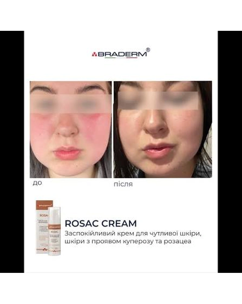 Заспокійливий крем для чутливої шкіри Braderm Rosac Cream, 30 мл