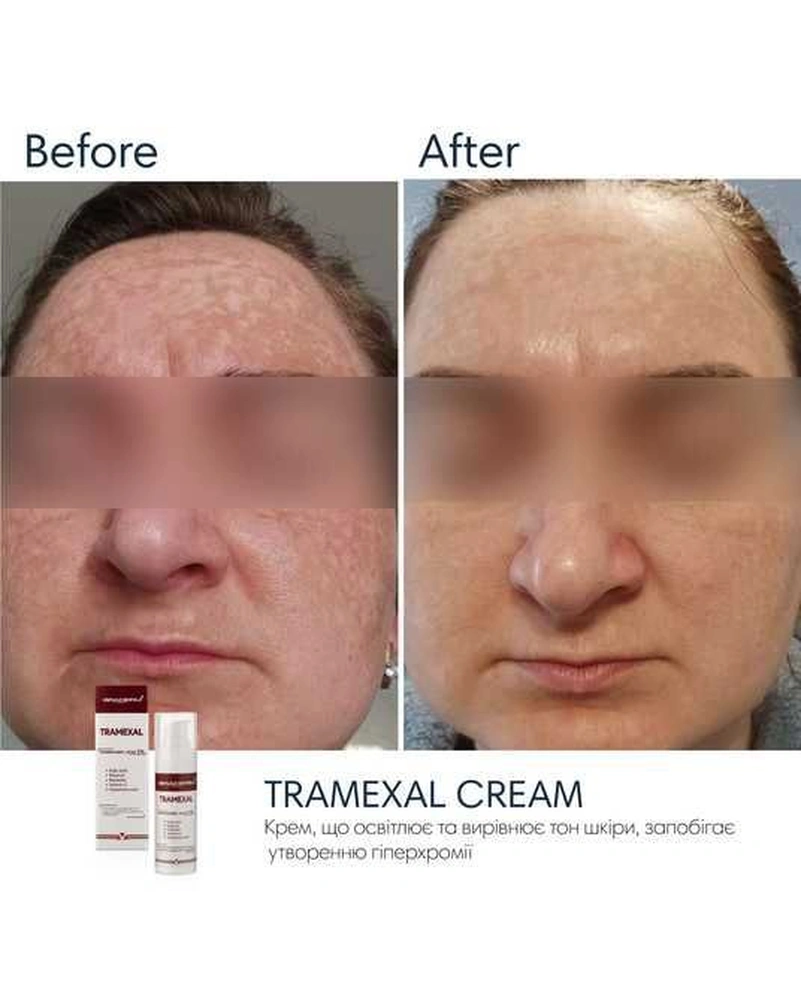 Освітлюючий крем проти пігментації Braderm Tramexal Cream, 30 мл