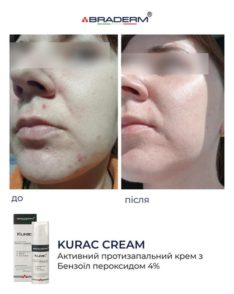 Активний протизапальний крем з бензоїл пероксидом 4% Braderm Kurac Cream, 30 мл