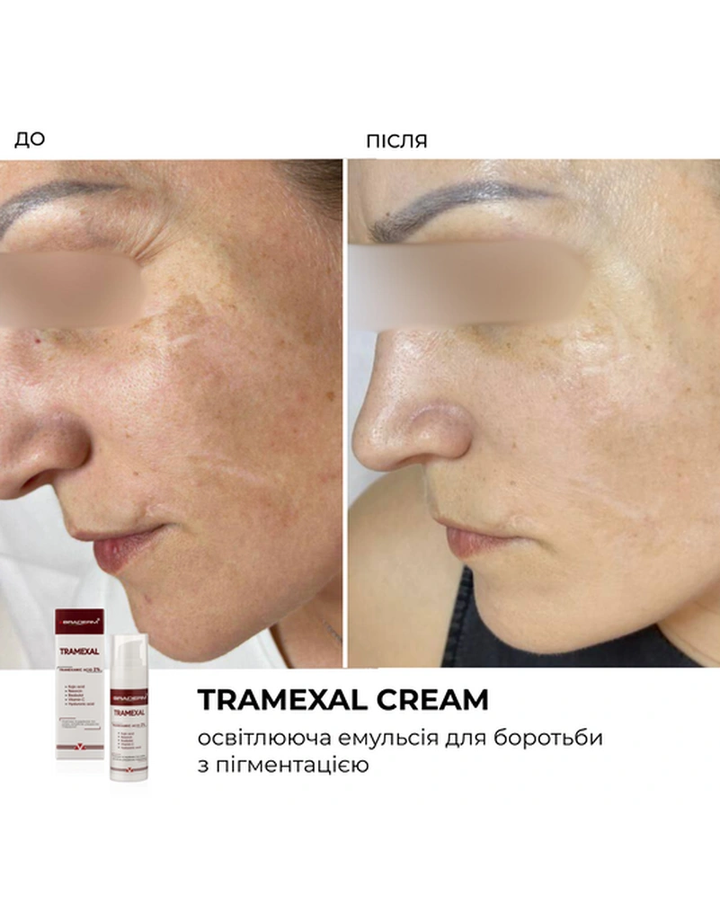 Освітлюючий крем проти пігментації Braderm Tramexal Cream, 30 мл