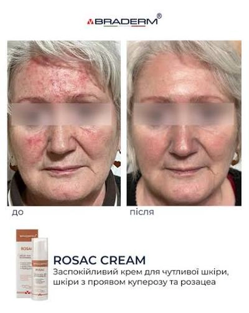 Заспокійливий крем для чутливої шкіри Braderm Rosac Cream, 30 мл